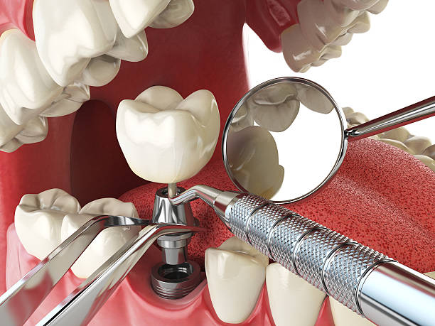 Best Emergency Dentist for Lost Fillings or Crowns in Kingsville, MD